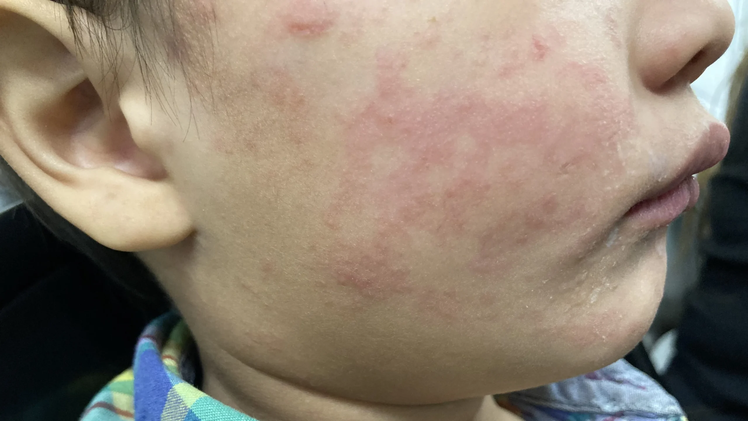 Measles Resurgence: What You Need to Know About the Latest Outbreak in the U.S.